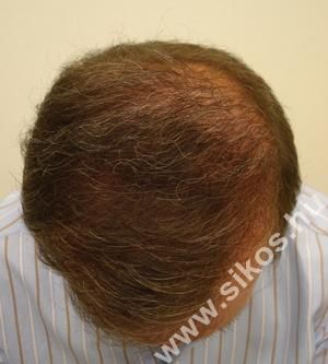 Hajátültetés, hajbeültetés után