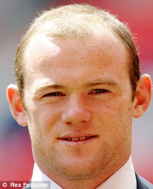 Rooney hajbeültetés előtt